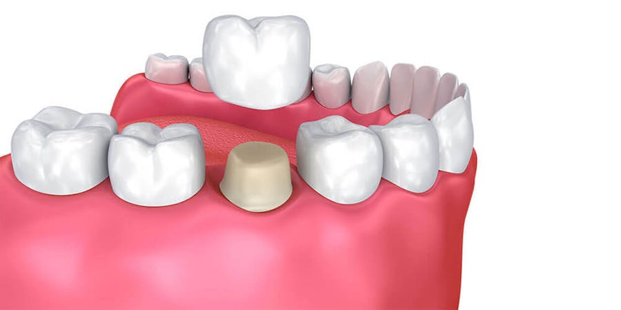 Coroane dentare Ploiesti